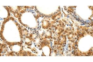 Immunohistochemistry of paraffin-embedded Human thyroid cancer using Otocadherin Polyclonal Antibody at dilution of 1:80 (CDH23 antibody)