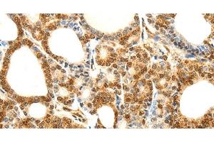 Immunohistochemistry of paraffin-embedded Human thyroid cancer using Otocadherin Polyclonal Antibody at dilution of 1:80