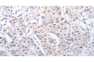 Immunohistochemistry of paraffin-embedded Human lung cancer using SLC39A6 Polyclonal Antibody at dilution of 1:30 (SLC39A6 antibody)