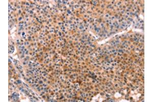 The image on the left is immunohistochemistry of paraffin-embedded Human liver cancer tissue using ABIN7129127(CYP1B1 Antibody) at dilution 1/20, on the right is treated with fusion protein. (CYP1B1 antibody)