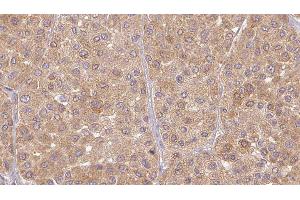 ABIN6277480 at 1/100 staining Human Melanoma tissue by IHC-P. (Neurotrophin 3 antibody  (Internal Region))