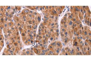 Immunohistochemistry of paraffin-embedded Human liver cancer tissue using Ephrin A5 Polyclonal Antibody at dilution 1:40 (Ephrin A5 antibody)