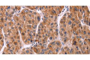 Immunohistochemistry of paraffin-embedded Human liver cancer tissue using Ephrin A5 Polyclonal Antibody at dilution 1:40