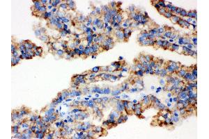 Anti- ALDH2 Picoband antibody, IHC(P) IHC(P): Human Kidney Cancer Tissue (ALDH2 antibody  (N-Term))