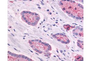Anti-GPR87 antibody IHC of human Prostate, Carcinoma. (GPR87 antibody  (N-Term))