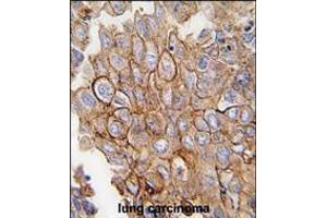Formalin-fixed and paraffin-embedded human lung carcinoma tissue reacted with ANXA2 antibody , which was peroxidase-conjugated to the secondary antibody, followed by DAB staining. (Annexin A2 antibody  (C-Term))