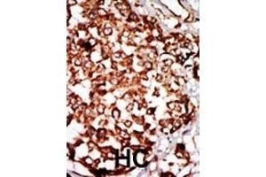 Formalin-fixed and paraffin-embedded human cancer tissue reacted with the primary antibody, which was peroxidase-conjugated to the secondary antibody, followed by DAB staining. (NRBP1 antibody  (N-Term))