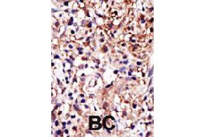 Formalin-fixed and paraffin-embedded human cancer tissue reacted with CAPRIN1 polyclonal antibody  , which was peroxidase-conjugated to the secondary antibody, followed by DAB staining . (Caprin-1 antibody  (AA 625-654))