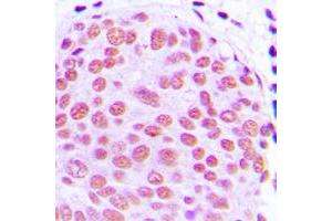 Immunohistochemical analysis of c-Jun staining in human breast cancer formalin fixed paraffin embedded tissue section.