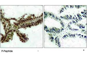 Immunohistochemical analysis of paraffin-embedded human lung carcinoma tissue using AKT1 (phospho T308) polyclonal antibody . (AKT1 antibody  (pThr308))