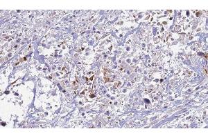 ABIN6277521 at 1/100 staining Human urothelial cancer tissue by IHC-P.