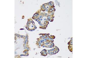 Immunohistochemistry of paraffin-embedded Human thyroid cancer using DYNLRB1 Rabbit pAb (ABIN7266866) at dilution of 1:100 (40x lens). (DYNLRB1 antibody  (AA 1-63))