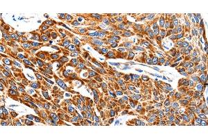 Immunohistochemistry of paraffin-embedded Human esophagus cancer using HSP75 Polyclonal Antibody at dilution of 1:100 (TRAP1 antibody)
