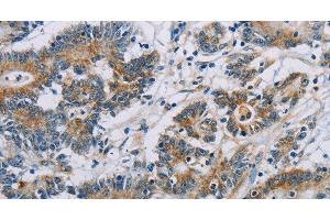 Immunohistochemistry of paraffin-embedded Human colon cancer using CSNK1E Polyclonal Antibody at dilution of 1:60 (CK1 epsilon antibody)