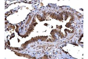 IHC-P Image CD74 antibody [N1N2], N-term detects CD74 protein at cytoplasm on human lung carcinoma by immunohistochemical analysis. (CD74 antibody  (N-Term))