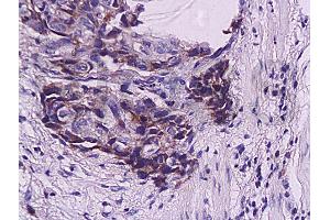 Formalin-fixed and paraffin embedded human esophageal carcinoma labeled with Anti-WIG-1/PAG608 Polyclonal Antibody, Unconjugated (ABIN730108) at 1:200, followed by conjugation to the secondary antibody and DAB staining (ZMAT3 antibody  (AA 201-288))