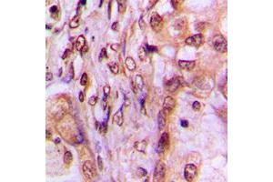 Immunohistochemical analysis of MAF1 staining in human breast cancer formalin fixed paraffin embedded tissue section.