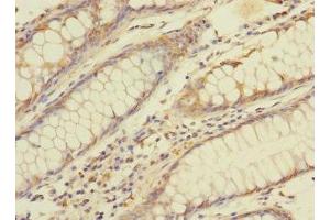 Immunohistochemistry of paraffin-embedded human colon cancer using ABIN7145902 at dilution of 1:100 (BTNL3 antibody  (AA 18-237))