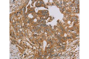 Immunohistochemistry of Human cervical cancer using NDUFA10 Polyclonal Antibody at dilution of 1:40