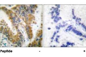 Immunohistochemical analysis of paraffin-embedded human lung carcinoma tissue, using CRKL polyclonal antibody . (CrkL antibody)