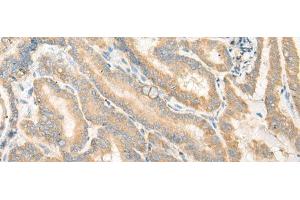 Immunohistochemistry of paraffin-embedded Human thyroid cancer tissue using EPB41L4B Polyclonal Antibody at dilution of 1:35(x200) (EPB41L4B antibody)