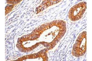Immunohistochemistry (IHC) image for anti-Carcinoembryonic Antigen Gene Family (CEA) antibody (ABIN3178614) (CEA antibody)