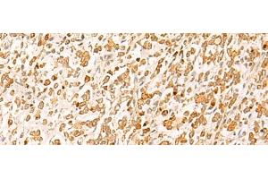 Immunohistochemistry of paraffin-embedded Human gastric cancer tissue using HTT Polyclonal Antibody at dilution of 1:25(x200) (Huntingtin antibody)