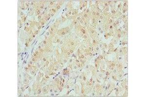 Immunohistochemistry of paraffin-embedded human gastric cancer using ABIN7145471 at dilution of 1:100 (CRYGS antibody  (AA 1-178))