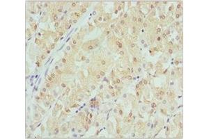 Immunohistochemistry of paraffin-embedded human gastric cancer using ABIN7145471 at dilution of 1:100