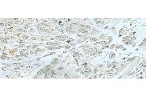 Immunohistochemistry of paraffin-embedded Human lung cancer tissue using THTPA Polyclonal Antibody at dilution of 1:70(x200) (THTPA antibody)