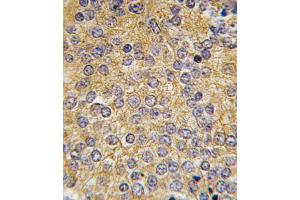Formalin-fixed and paraffin-embedded human prostata carcinoma tissue reacted with PLAU antibody (N-term), which was peroxidase-conjugated to the secondary antibody, followed by DAB staining. (PLAU antibody  (N-Term))