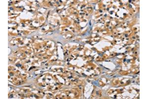 The image on the left is immunohistochemistry of paraffin-embedded Human thyroid cancer tissue using ABIN7130690(PPP3CA Antibody) at dilution 1/30, on the right is treated with fusion protein. (PPP3CA antibody)