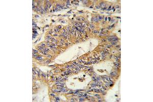 Formalin-fixed and paraffin-embedded human colon carcinoma reacted with IL17RB Antibody (Center), which was peroxidase-conjugated to the secondary antibody, followed by DAB staining. (IL17 Receptor B antibody  (AA 207-234))