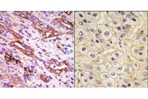 (LEFT)Formalin-fixed and paraffin-embedded human cancer tissue reacted with the primary antibody, which was peroxidase-conjugated to the secondary antibody, followed by DAB staining.