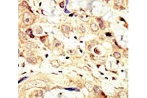 IHC analysis of FFPE human breast carcinoma tissue stained with the HER4 antibody (ERBB4 antibody  (AA 25-55))