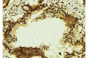 ABIN6274346 at 1/100 staining Human breast cancer tissue by IHC-P.