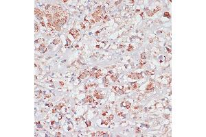 Immunohistochemistry of paraffin-embedded Human breast cancer using Desmoplakin antibody (ABIN6134106, ABIN6139838, ABIN6139840 and ABIN6223548) at dilution of 1:100 (40x lens). (Desmoplakin antibody  (AA 1-100))