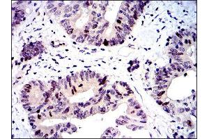 Immunohistochemistry (IHC) image for anti-Baculoviral IAP Repeat-Containing 5 (BIRC5) antibody (ABIN1845166) (Survivin antibody)