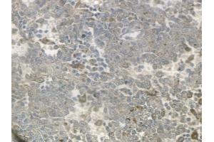 ABIN6259318 and ABIN6274720 at 1/100 staining human melanoma by IHC-P.