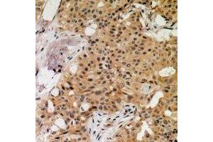 Immunohistochemical analysis of MNK1 (pT250) staining in human breast cancer formalin fixed paraffin embedded tissue section.