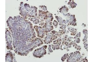 IHC-P Image Immunohistochemical analysis of paraffin-embedded human lung cancer, using MDM2, antibody at 1:500 dilution. (MDM2 antibody  (Center))