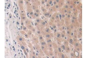 IHC-P analysis of Human Liver cancer Tissue, with DAB staining.