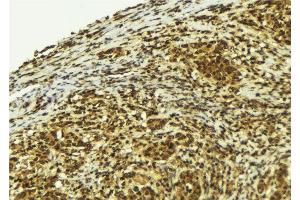ABIN6279170 at 1/100 staining Human breast cancer tissue by IHC-P. (PIF1 antibody  (Internal Region))