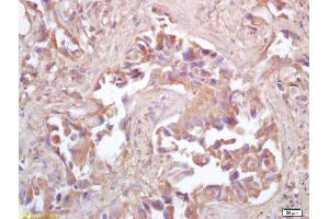 Formalin-fixed and paraffin embedded human lung carcinoma labeled with Rabbit Anti HSP10/CPN10 Polyclonal Antibody, Unconjugated (ABIN721885) at 1:200 followed by conjugation to the secondary antibody and DAB staining (HSPE1 antibody  (AA 51-102))