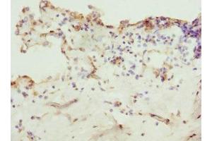 Immunohistochemistry of paraffin-embedded human breast cancer using ABIN7176368 at dilution of 1:100 (ZNF549 antibody  (AA 1-280))