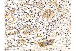 ABIN6260575 and ABIN6268769 at 1/100 staining Human pancreatic cancer by IHC-P.