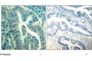 Immunohistochemical analysis of paraffin-embedded human colon carcinoma tissue using CDK6 (phospho Y24) polyclonal antibody . (CDK6 antibody  (pTyr24))