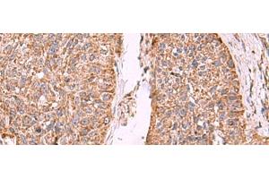 Immunohistochemistry of paraffin-embedded Human esophagus cancer tissue using PER3 Polyclonal Antibody at dilution of 1:55(x200) (PER3 antibody)