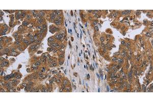 Immunohistochemistry of paraffin-embedded Human ovarian cancer using NDUFAF4 Polyclonal Antibody at dilution of 1:45 (NDUFAF4 antibody)