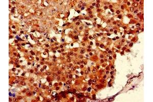 Immunohistochemistry of paraffin-embedded human breast cancer using ABIN7149126 at dilution of 1:100 (UBXN11 antibody  (AA 38-146))